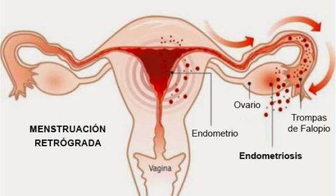 Disorders in menstruation: causes, types and treatments