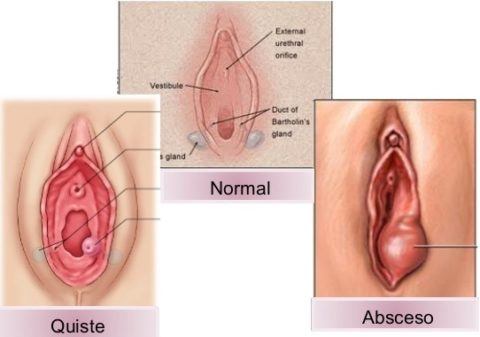 Bartolino's cyst | Symptoms, causes and treatment