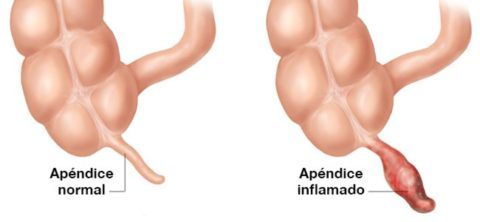 Gangrenous appendicitis: Causes, symptoms and diagnosis